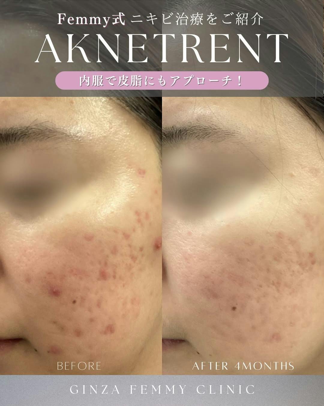 【女性・皮脂】イソトレチノイン・ケミカルピーリング_before_aftar