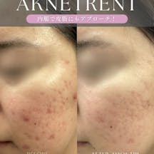 【女性・皮脂】イソトレチノイン・ケミカルピーリング_before_aftar