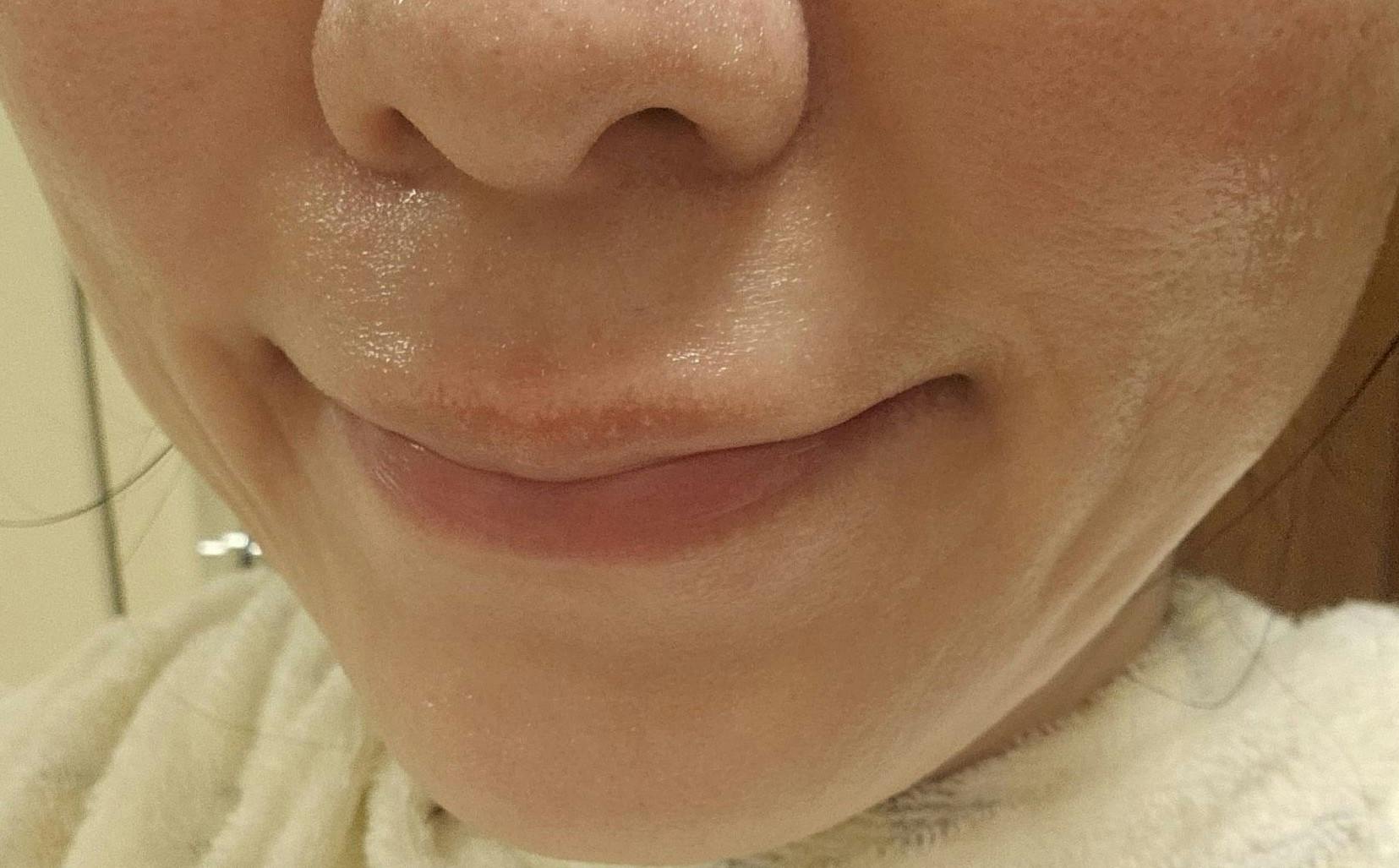 湘南美容クリニック 仙台院でトキシルスレッドを受けたYSさんの写真