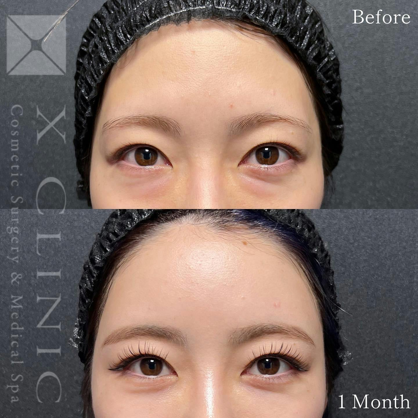 【20代女性・目元】クマ取りフルコース＋ベイビーおでこ＋PRP_before_aftar