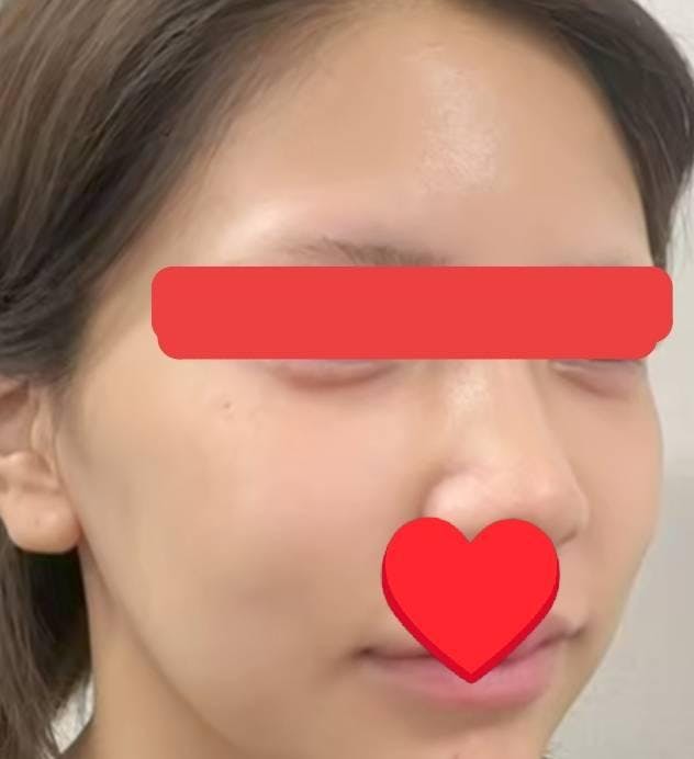聖心美容クリニック 横浜院で涙袋形成（涙堂形成）：ヒアルロン酸注入を受けたべぇちゃんさんの写真