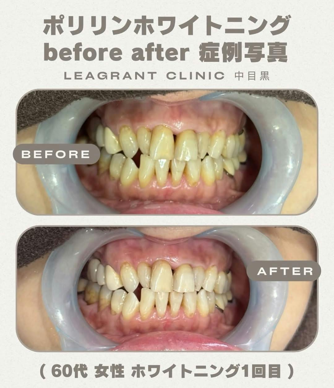 【60代女性・歯】ポリリンホワイトニング_before_aftar
