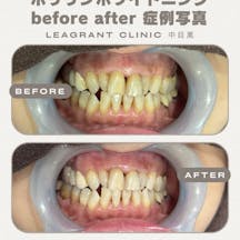 【60代女性・歯】ポリリンホワイトニング_before_aftar