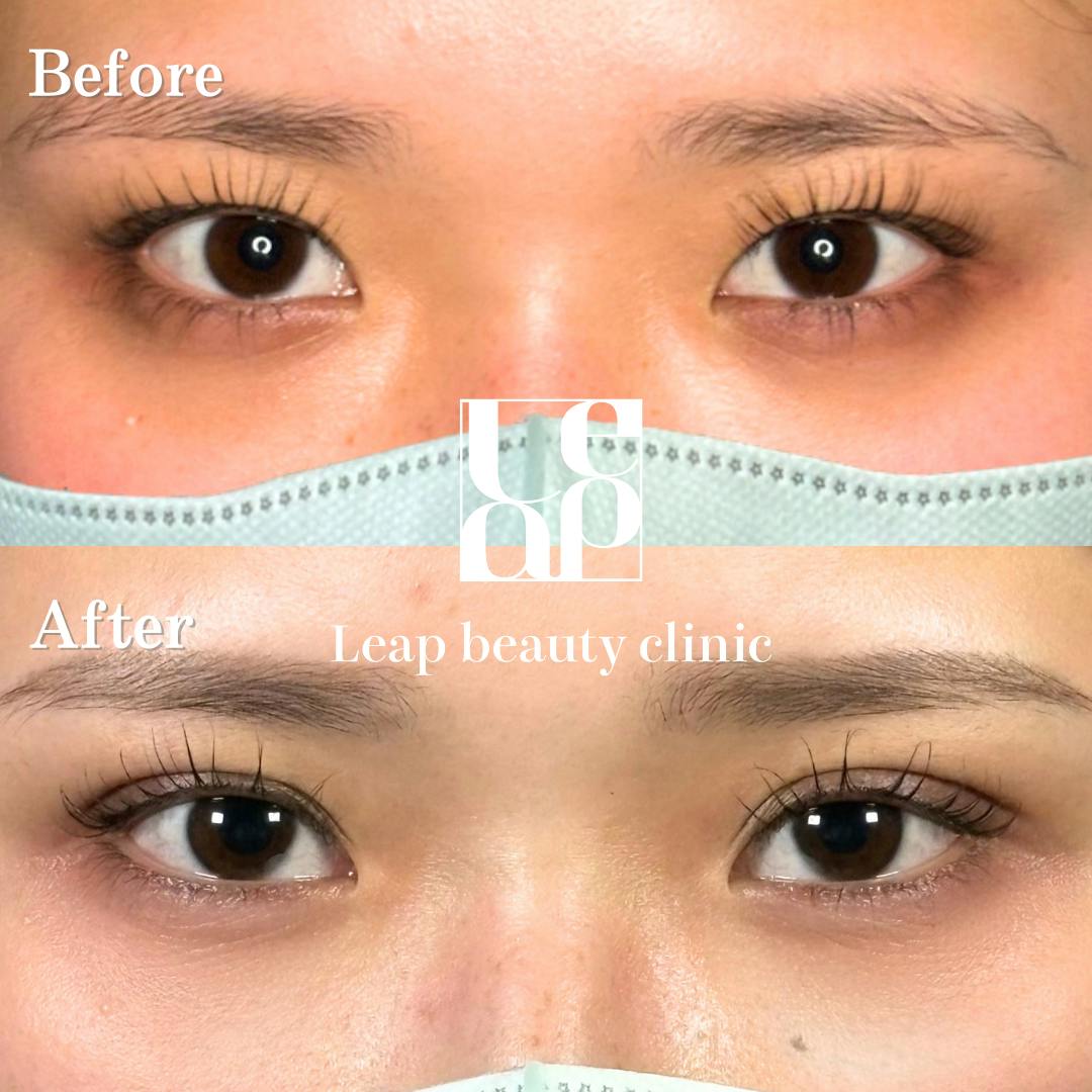 【20代女性・目元】二重埋没法・目の下の切らないたるみ取り_before_aftar