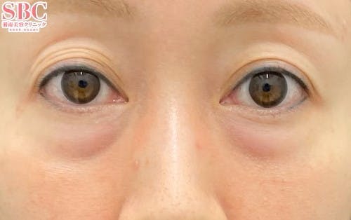 【女性・目元】裏ハムラ法 VOV（ボブ）リフト テスリフト_before