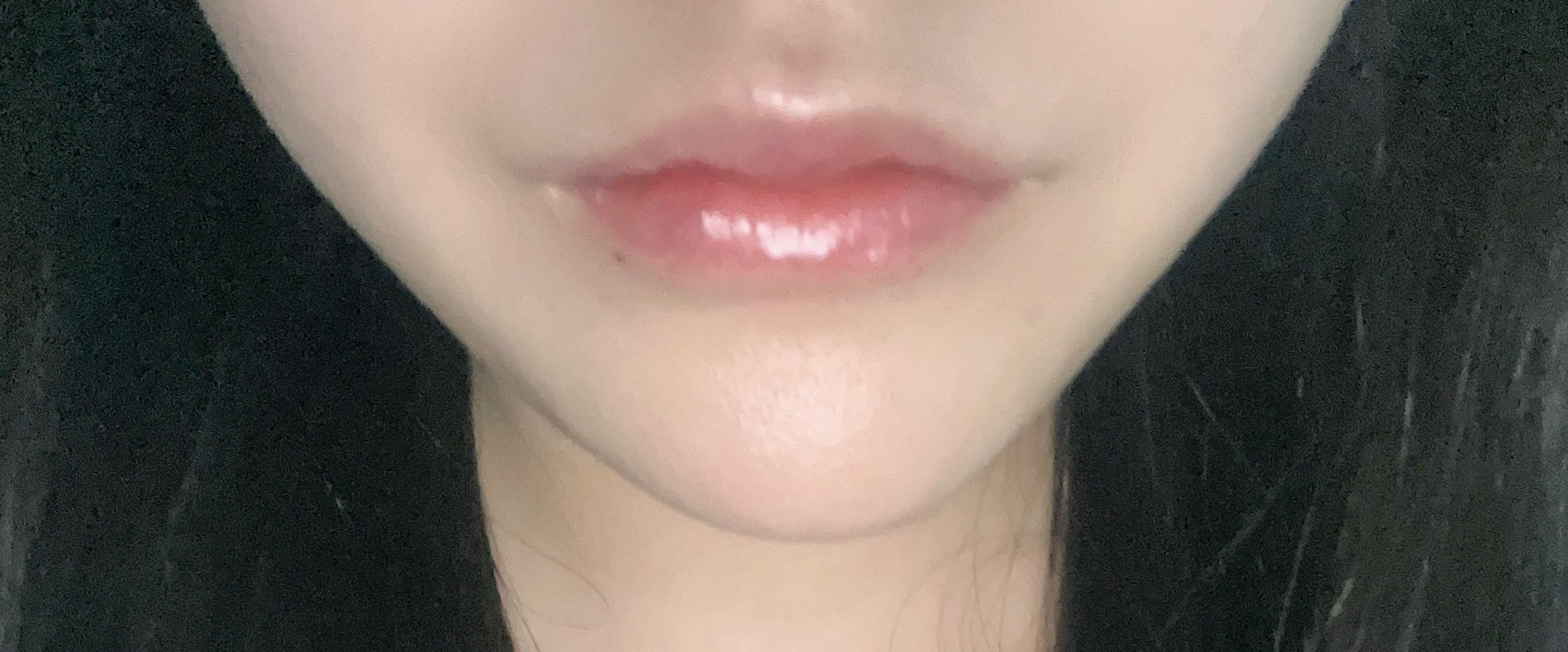 湘南美容クリニック 池袋メトロポリタン口院でを受けたあさんの写真