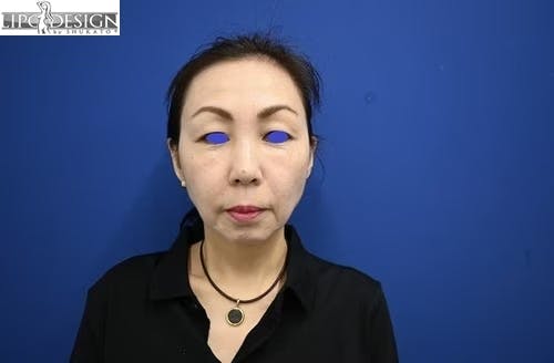 【52歳女性・輪郭】SBCプレミアムPRP皮膚再生療法、目の下の切らないクマ・たるみ（ふくらみ）取り_after