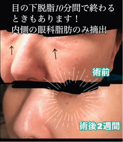 【女性・目元】目の下脱脂_before_aftar