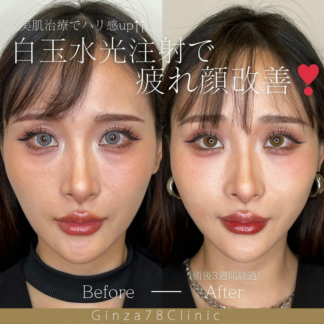 【女性・クマ】水光注射_before_aftar