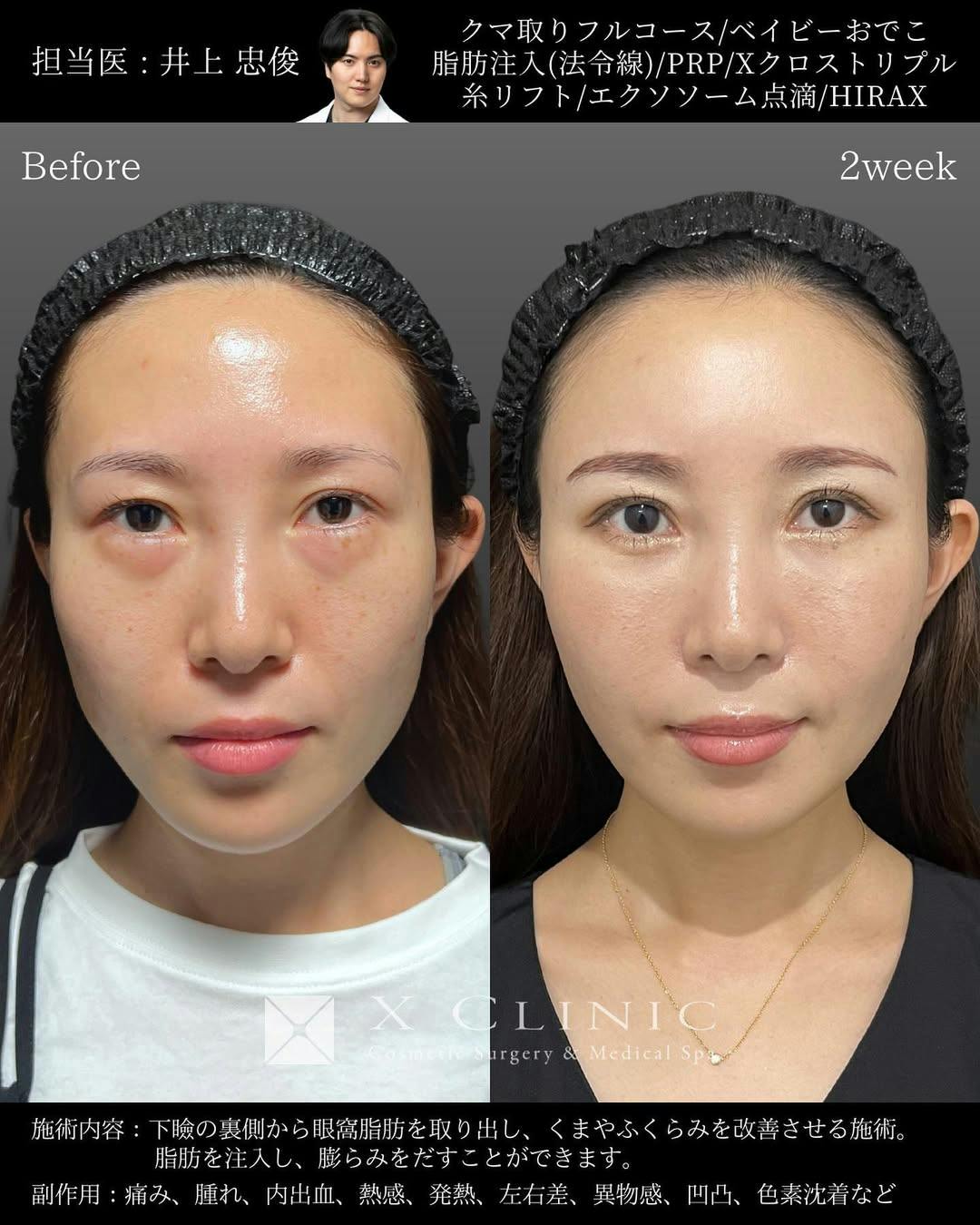 【30代女性・顔】クマ取りフルコース ベイビーおでこ（額こめかみ脂肪注入） 脂肪注入（ほうれい線） 糸リフト Xクロストリプル HIRAX（涙袋） PRP プレミアムエクソソーム点滴_before_aftar