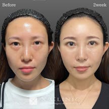 【30代女性・顔】クマ取りフルコース ベイビーおでこ(額こめかみ脂肪注入) 脂肪注入(ほうれい線) 糸リフト Xクロストリプル HIRAX(涙袋) PRP プレミアムエクソソーム点滴_before_aftar