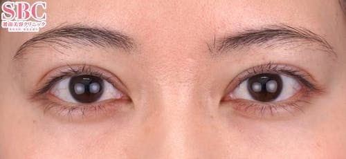 【30代女性・目元】クイックコスメティーク・トリプルNeo_after