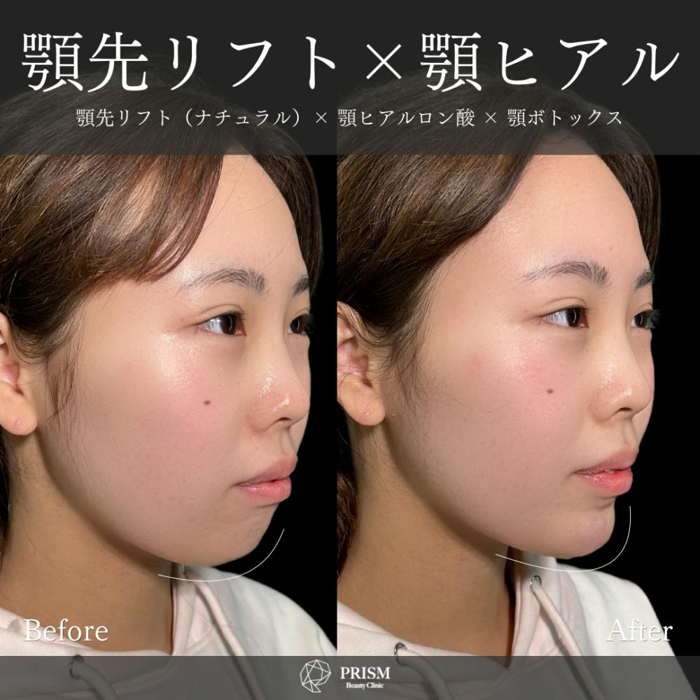 【20代女性・顎】あご先リフト＋ ヒアルロン酸（顎）＋ボトックス（顎）_before_aftar