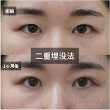 【30代女性・目元】二重埋没法_before_aftar