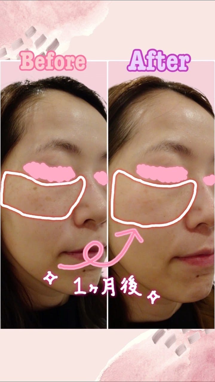 【女性・そばかす】フォトフェイシャル_before_aftar