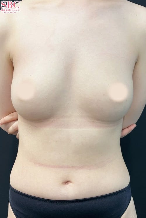 【女性・胸】Aquicell（アキーセル）併用セルーション(脂肪注入豊胸)・セルーション(脂肪注入豊胸)_after