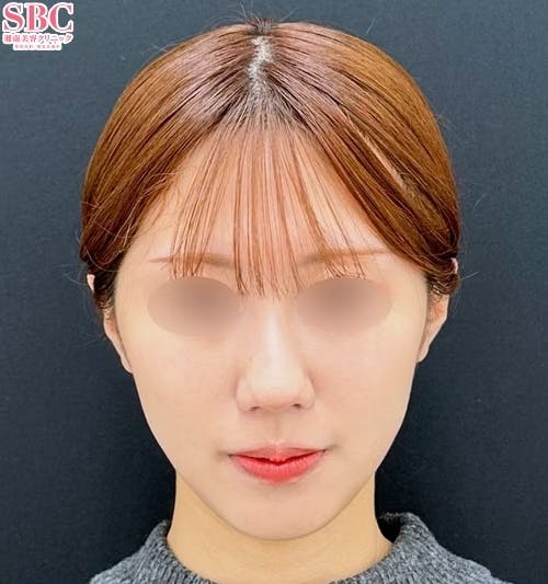 【10代女性・顔・頬・顎】Aquicell(アキーセル)脂肪吸引・ジョールファット除去術・糸リフト_after