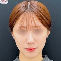 【10代女性・顔・頬・顎】Aquicell(アキーセル)脂肪吸引・ジョールファット除去術・糸リフト_after