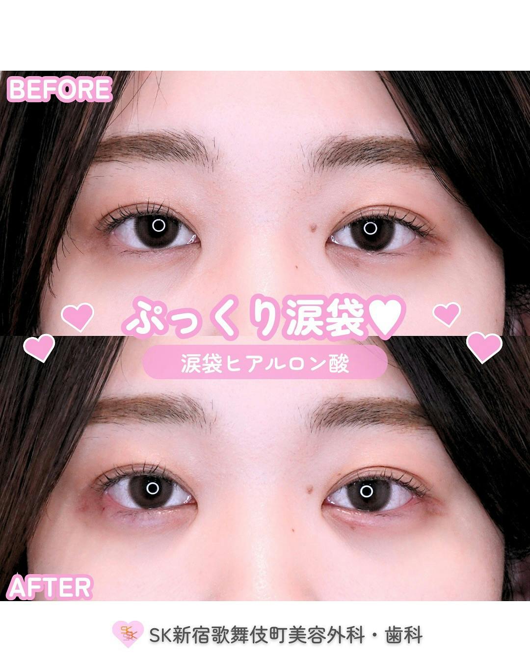 【女性・目元】涙袋ヒアルロン酸_before_aftar