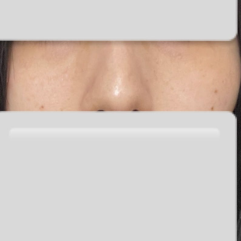 南青山トクナカクリニック(南青山TOKUNAKAクリニック)でルビーレーザー(Qスイッチルビーレーザー)・医療レーザー治療を受けたねこさんの写真