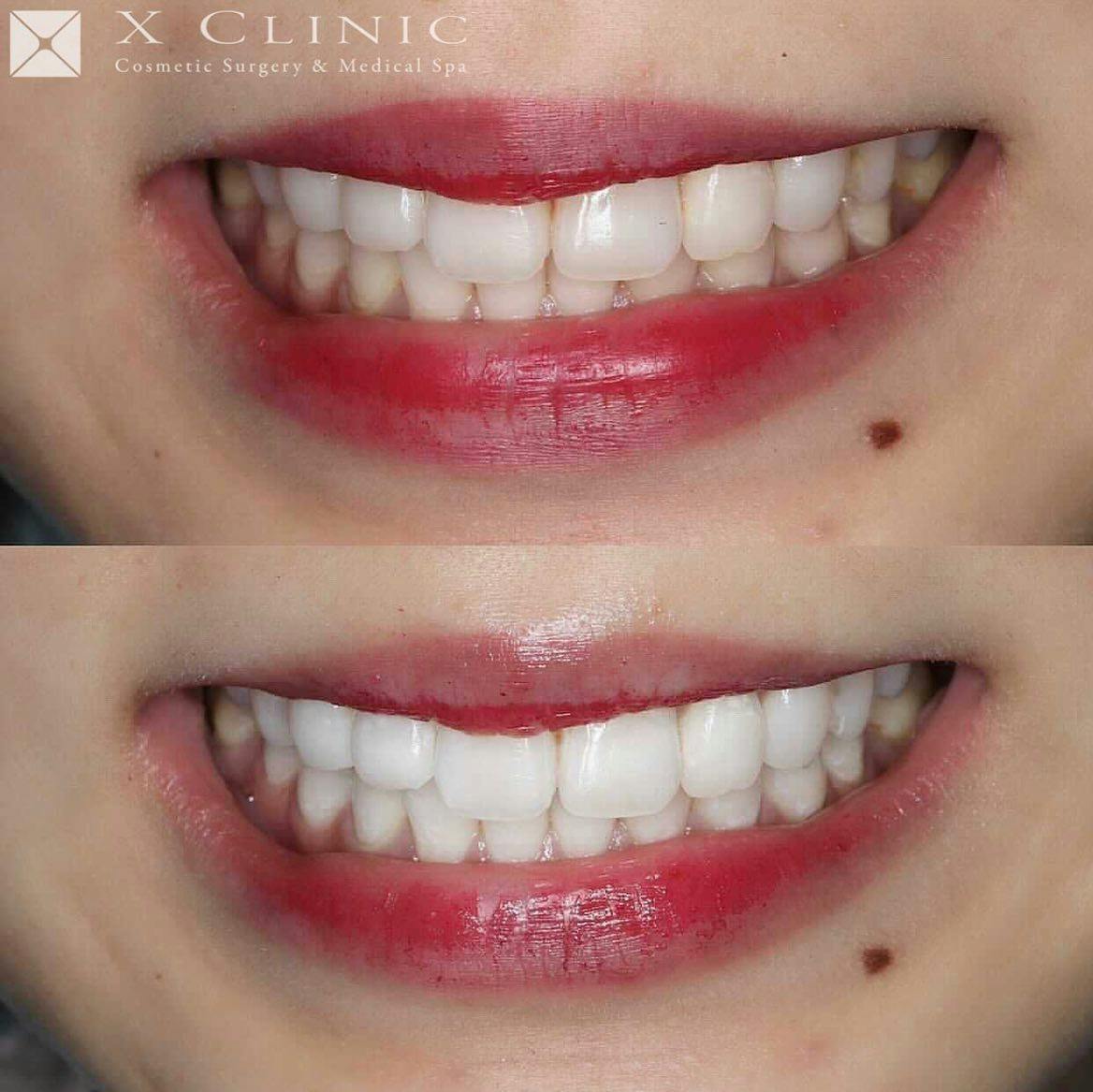 【女性・歯】オフィスホワイトニング_before_aftar