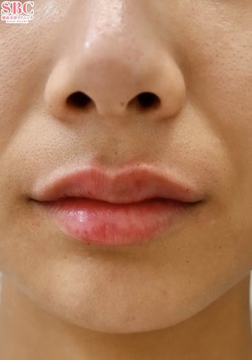 【女性・唇】ヒアルロン酸ジュビダームビスタ バイクロスシリーズ_aftar