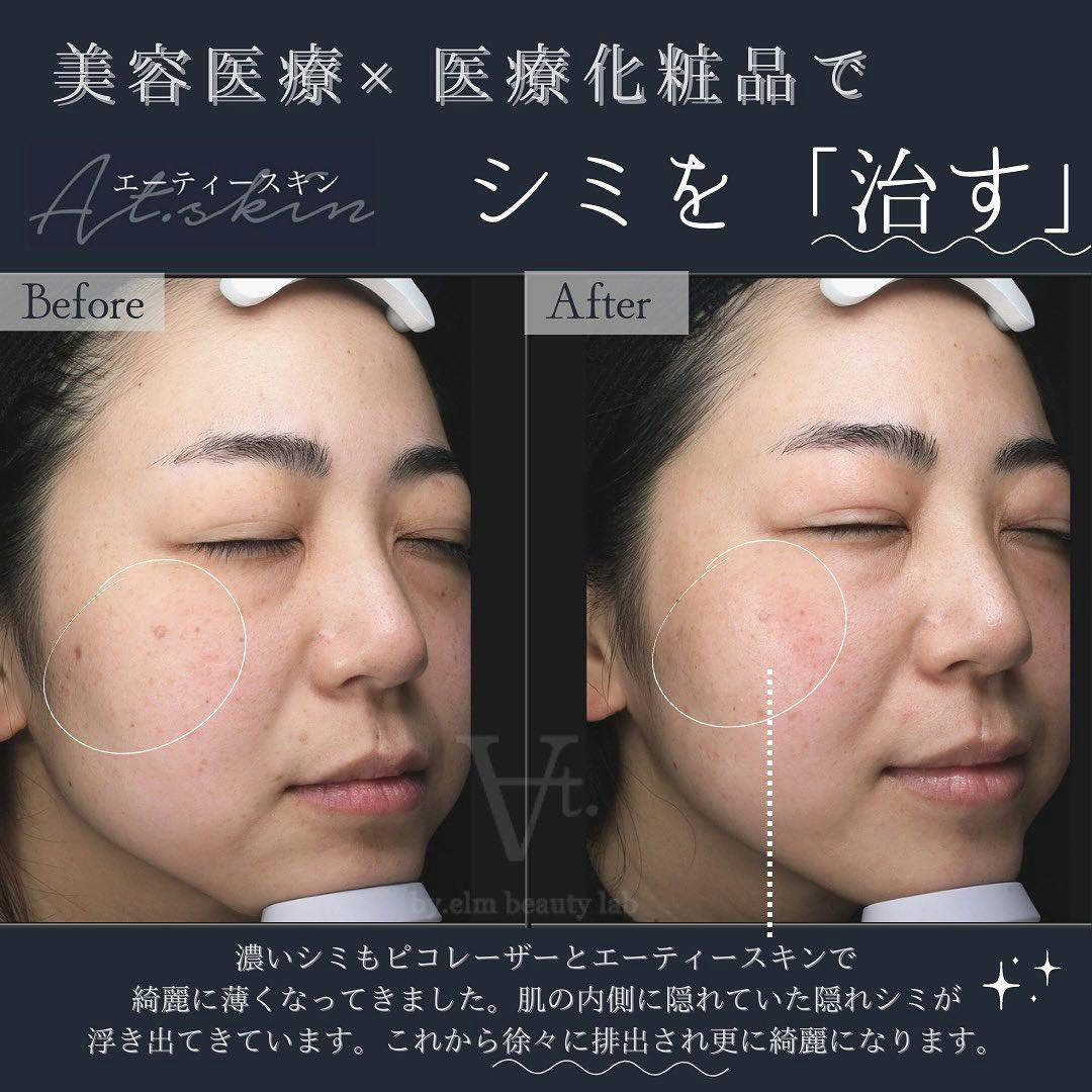 【女性・シミ】ピコレーザー・エーティースキン_before_aftar