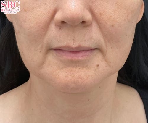 【50代女性・たるみ】VOV（ボブ）リフト ヒアルロン酸ジュビダームビスタ バイクロスシリーズ_before