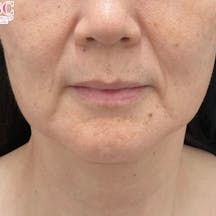 【50代女性・たるみ】VOV(ボブ)リフト ヒアルロン酸ジュビダームビスタ バイクロスシリーズ_before