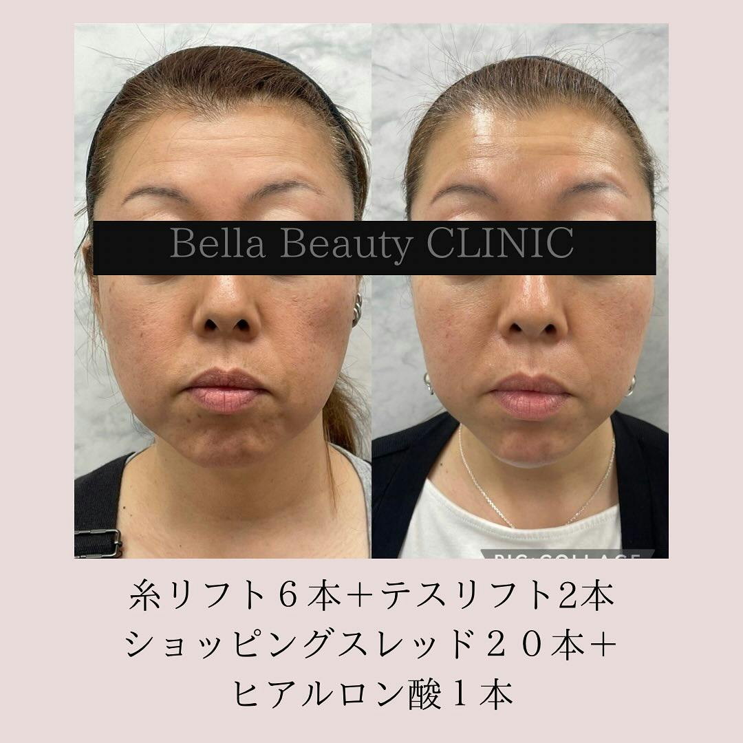 【女性・たるみ】糸リフト　フェイスライン_before_aftar