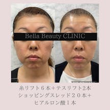 【女性・たるみ】糸リフト フェイスライン_before_aftar