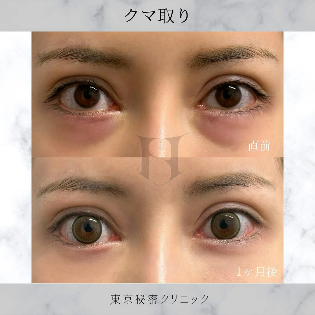 【女性・目元】クマ取り_before_aftar