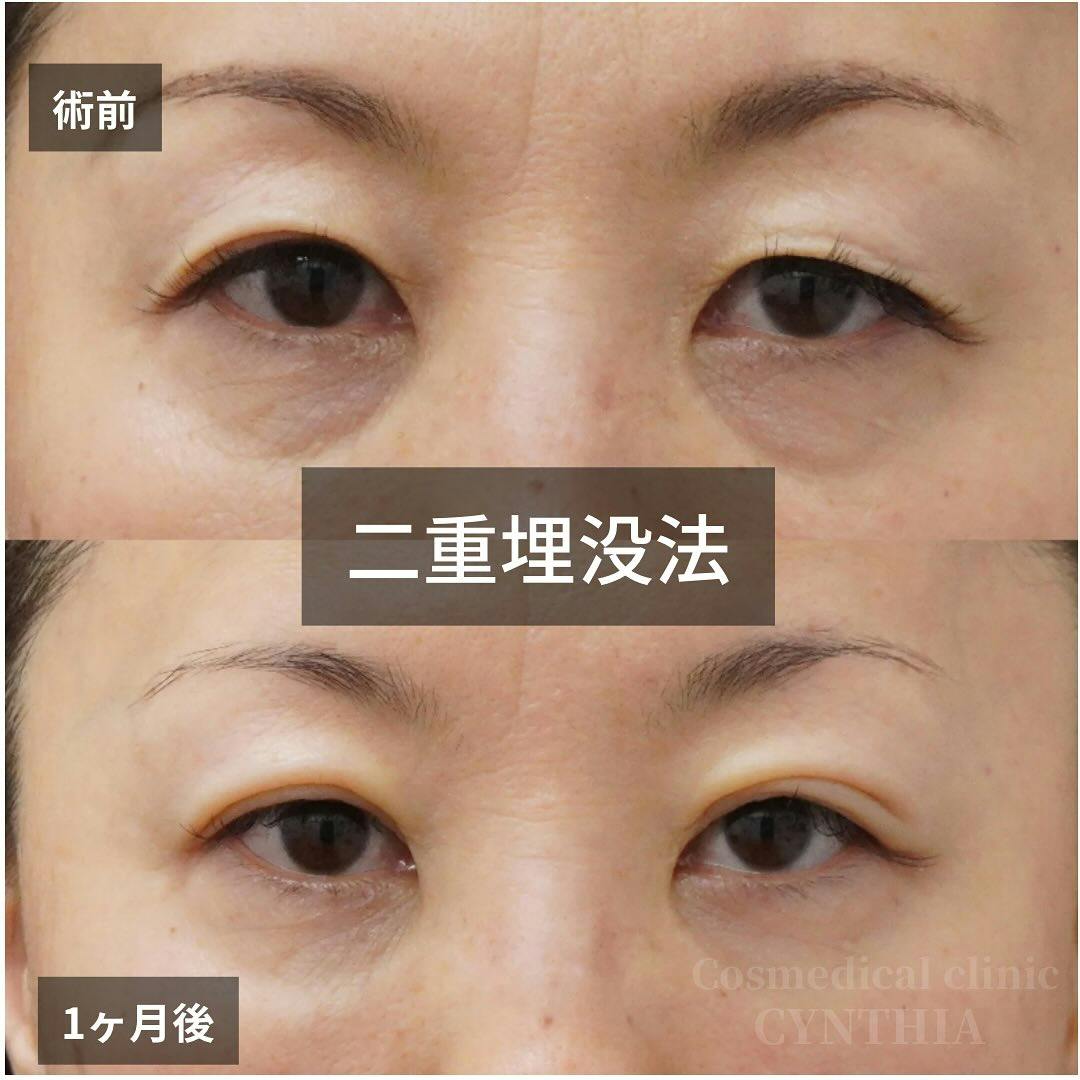 【女性・目元】二重埋没法_before_aftar