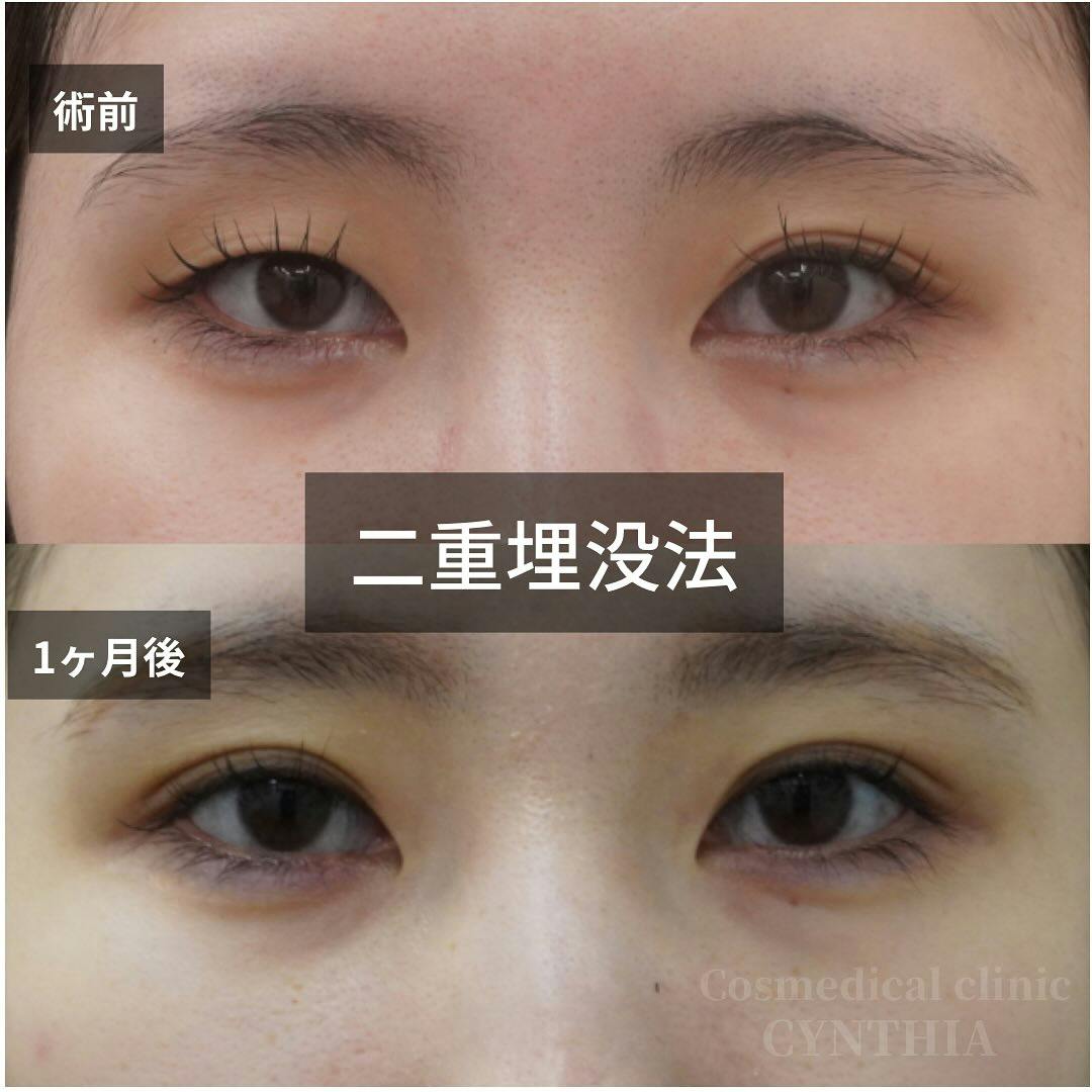 【20代女性・目元】二重埋没法_before_aftar