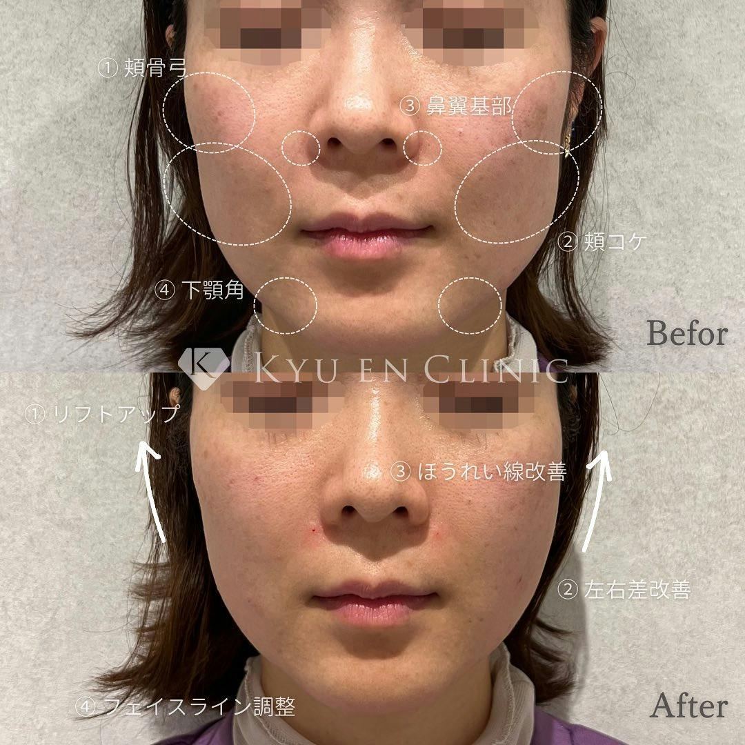 【女性・ほうれい線】ヒアルロン酸注入 _before_aftar