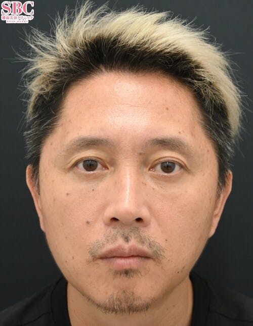 【50代男性・クマ】目の下の切らないクマ・たるみ（ふくらみ）取り ナチュラル脂肪注射コンデンスリッチ ナチュラル脂肪注射ナノリッチ_after