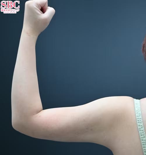 【女性・二の腕】根こそぎVASER脂肪吸引_after