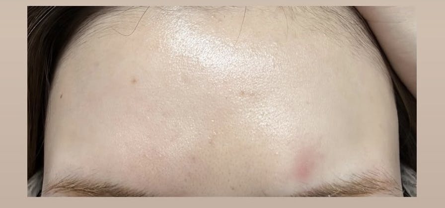 ソワカウィメンズヘルスクリニック(sowaka women’s health clinic)でポテンツァを受けたTiさんの写真