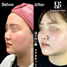 【20代女性・輪郭】頬・顎下脂肪吸引・TESSリフト_before_aftar