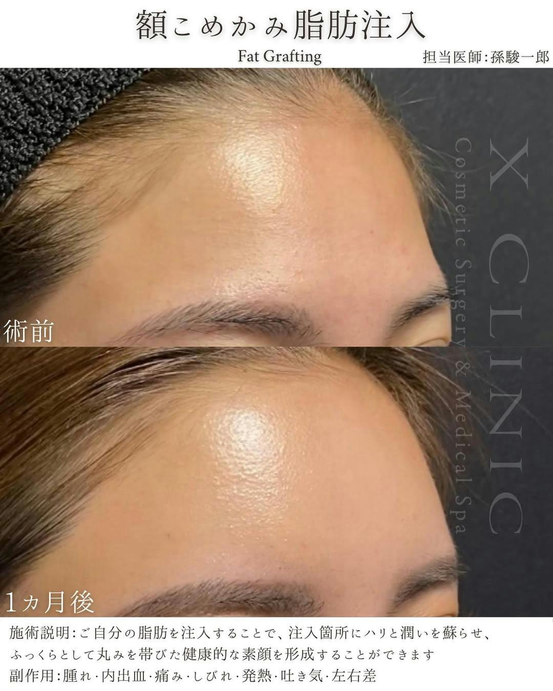 【女性・額】額こめかみ脂肪注入_before_aftar