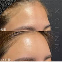 【女性・額】額こめかみ脂肪注入_before_aftar