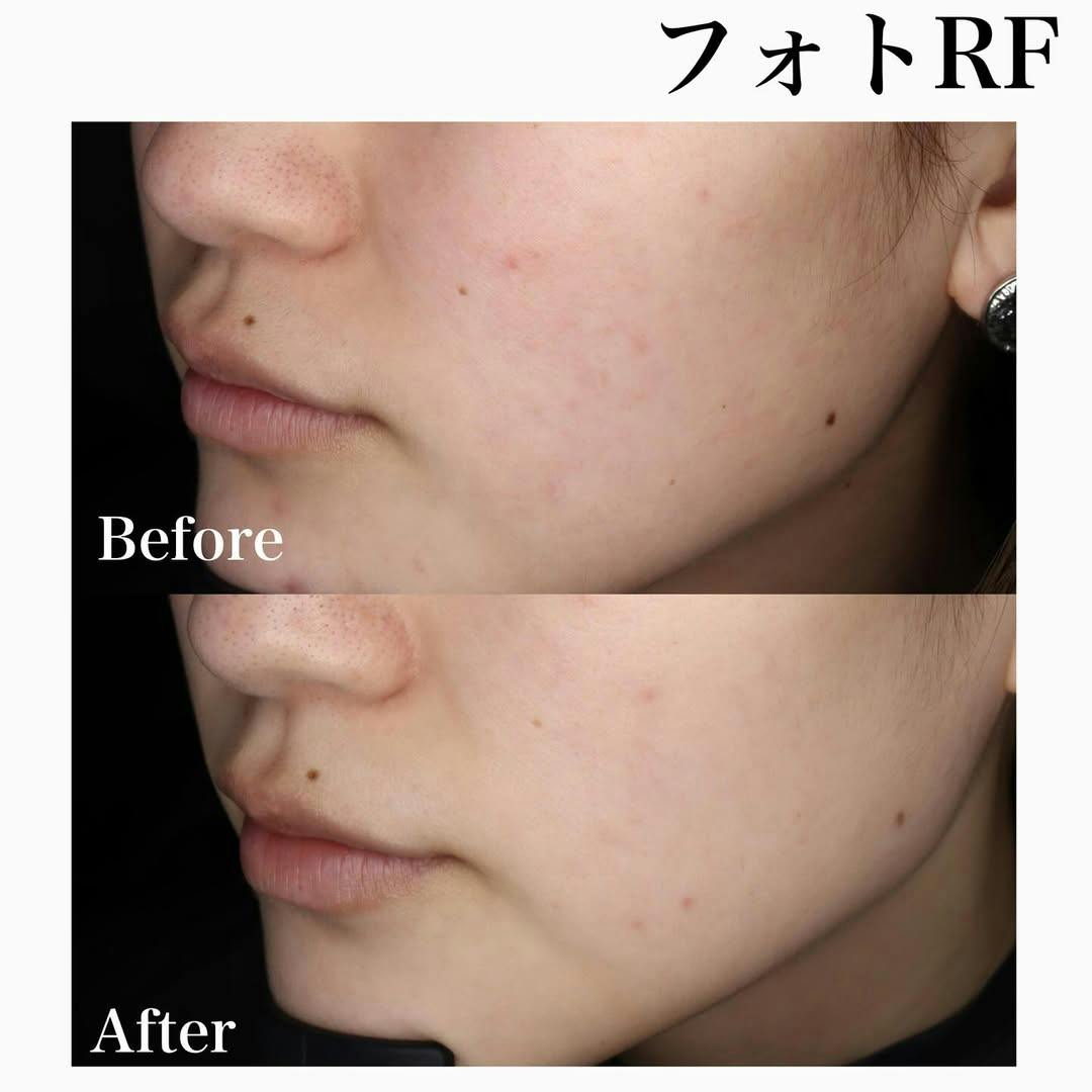 【女性・顔】フォトRF_before_aftar