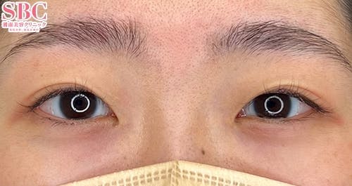 【20代女性・目元】クイックコスメティーク・ダブルNeo、ヒアルロン酸涙袋_before