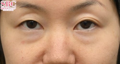 【40代女性・目元】目の下の切らないクマ・たるみ（ふくらみ）取り ナチュラル脂肪注射コンデンスリッチ ナチュラル脂肪注射ナノリッチ_before