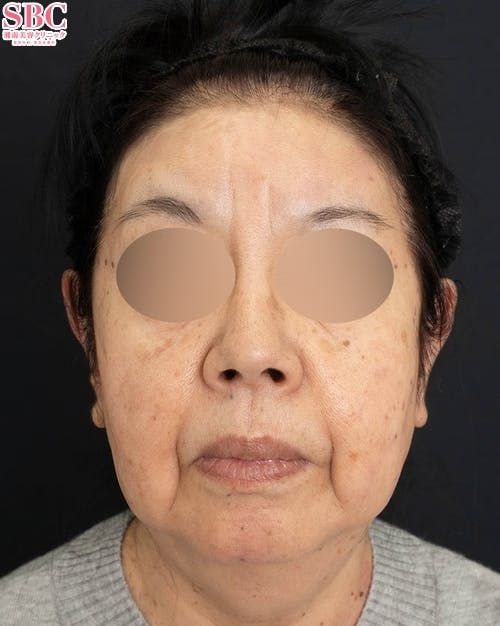 【70代女性・顔】ナチュラルクイックリフト、シークレットリフト、VOV（ボブ）リフト、VASER脂肪吸引（頬・アゴ下・ジョールファット）、SBCプリマリフト_before