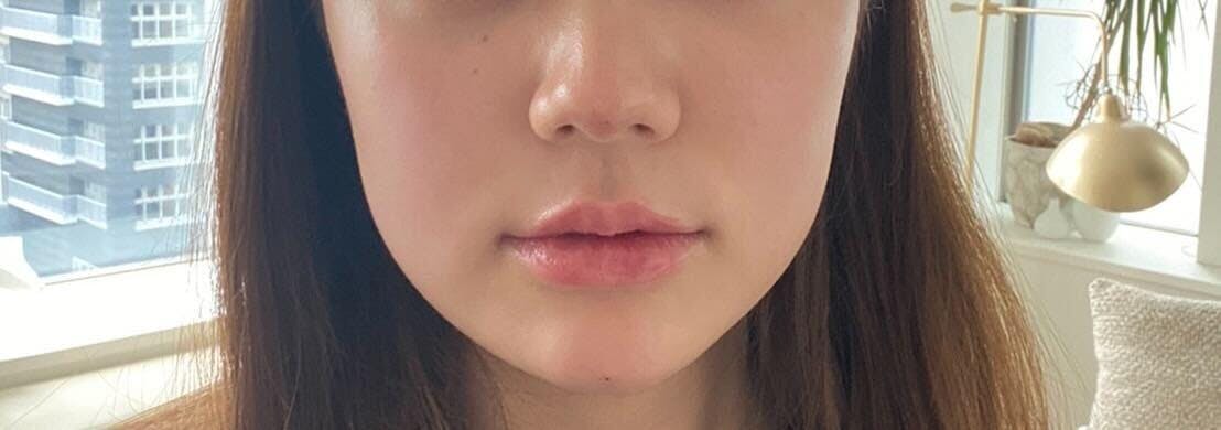 ビアンカ 銀座院(BIANCA)でヒアルロン酸注入：ヒアルロン酸注入を受けたひぐさんの写真