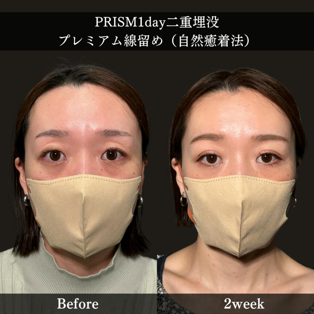 【40代女性・目】PRISM 1day二重埋没_before_aftar