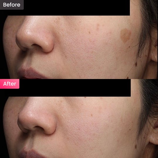 【女性・シミ】頬のシミが気になる