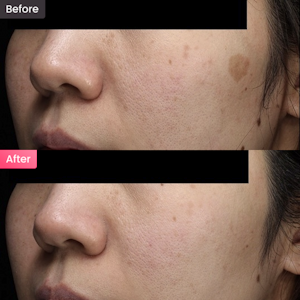 【女性・シミ】頬のシミが気になる