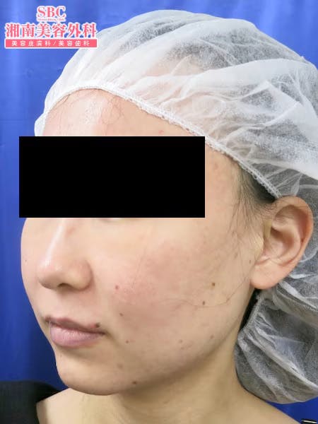 【女性・顔】根こそぎVASER脂肪吸引・ライポマティック脂肪吸引_before